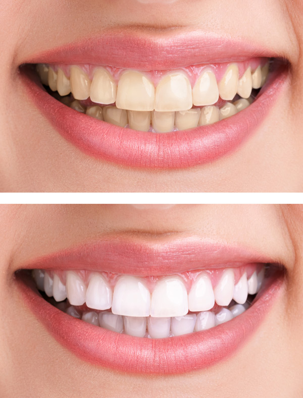 Blanqueamiento Dental Barcelona