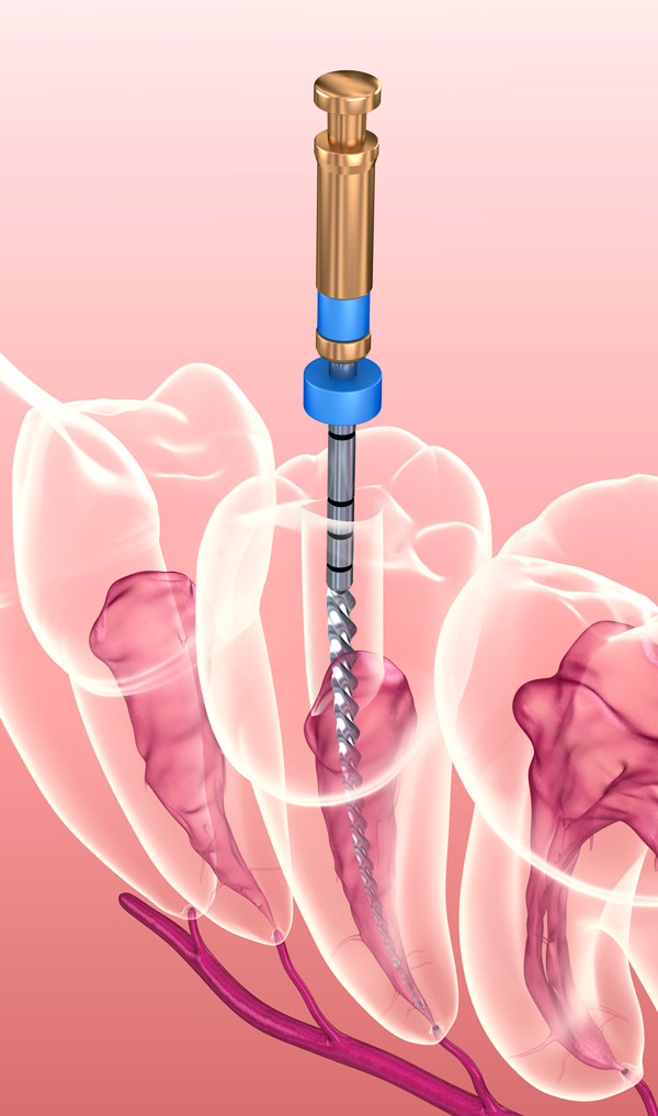 Endodoncia Barcelona