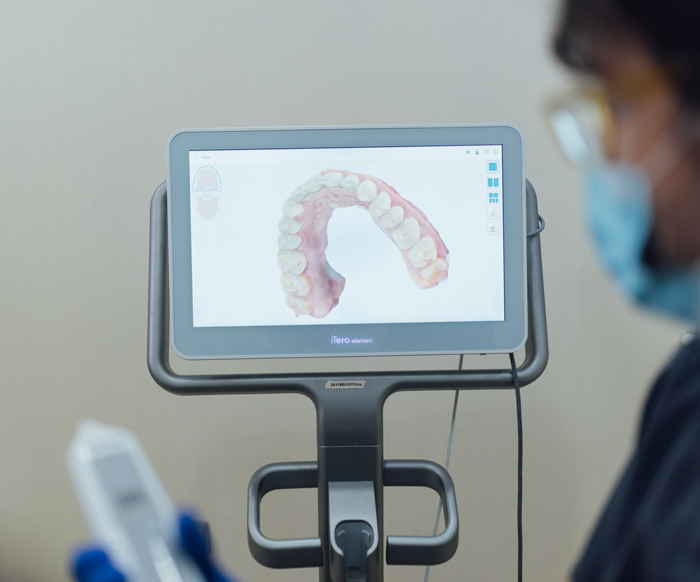 Escáner intraoral iTero